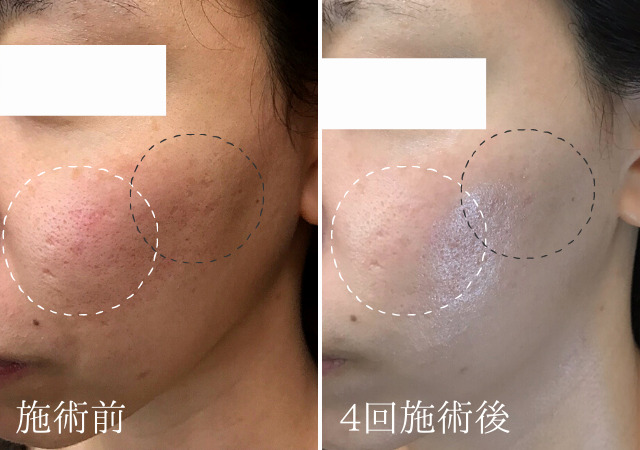 なぜ ハーブピーリングでニキビ跡 クレーターが改善するの