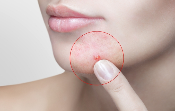 東京 ニキビ専門ハーブピーリングエステ