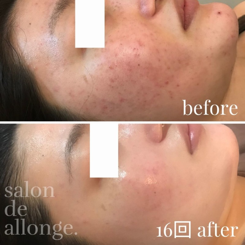 東京赤羽 ニキビの為のハーブピーリング