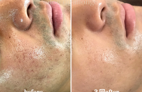 東京のニキビ ニキビ跡専門 きもちいい美肌ハーブピーリング