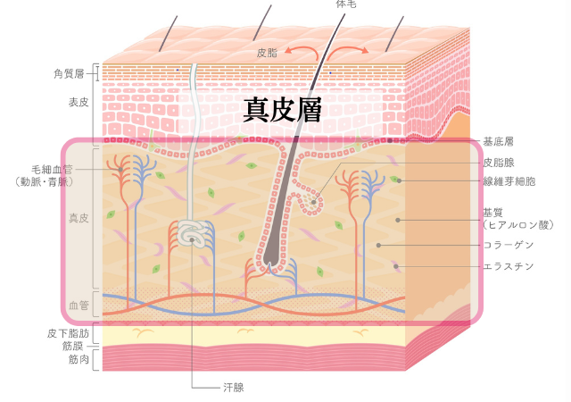 クレーターのダメージは真皮層