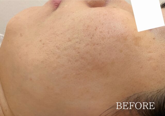 CO2フラクショナルをやってもクレーターが治らない