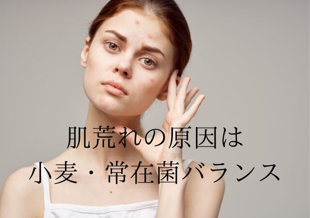 ニキビの原因は、小麦と常在菌バランス