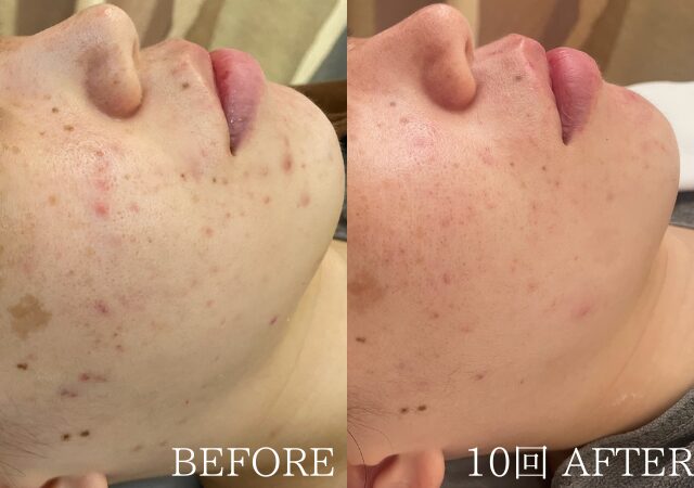 ニキビができてはシミになっていく