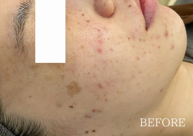 産後にニキビが悪化し、皮膚科のニキビ薬も効かない