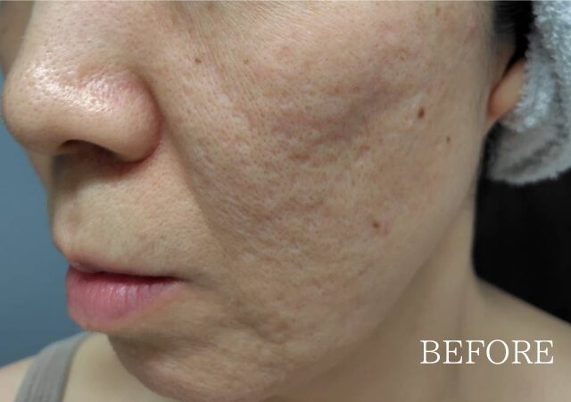 ニキビ跡のボコボコクレーターが気になる