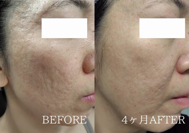 化粧品だけでクレーターが綺麗に改善