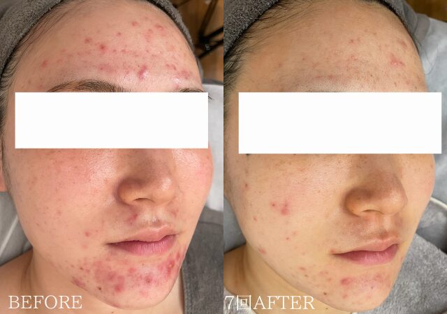 皮膚科に通っても、何をしても治らない顎ニキビが改善