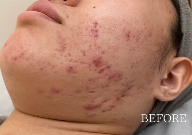 フェイスラインのニキビがひどく、赤い炎症ニキビ、膿の溜まった黄ニキビ、クレーターが混在する肌状態