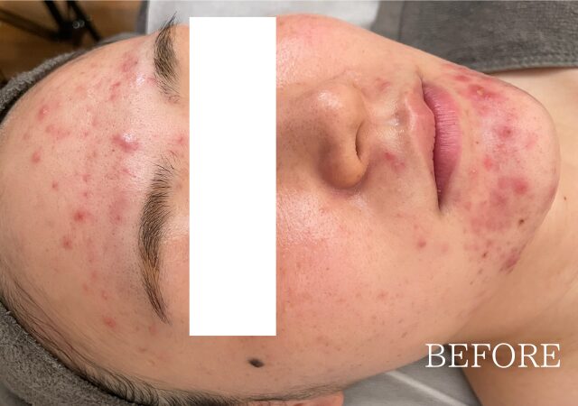 顎、額だけにニキビを繰り返す