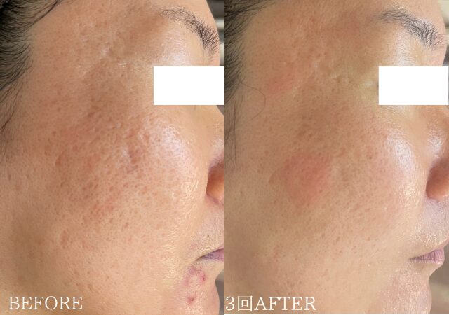 46歳女性ニキビ跡のクレーター改善事例ハーブピーリング施術