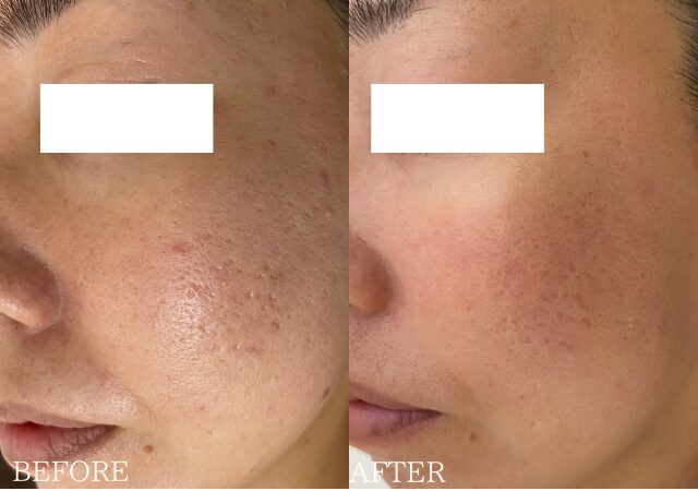 50歳女性、ハーブピーリング、トライフィルプロ、クレーター肌改善事例、ニキビ、ニキビ跡専門サロンアロンジェ