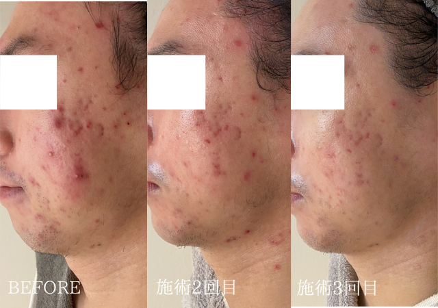25歳男性の繰り返すニキビの症例写真。施術前と施術3回目来店時の頬の比較